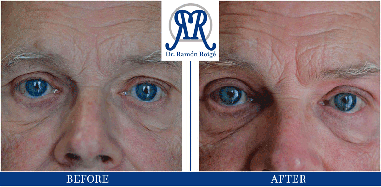 treatment against wrinkles in upper eyelid